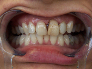 Veneers and crowns before picture